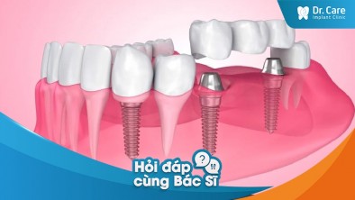 [Hỏi đáp bác sĩ] Tôi đang sử dụng cầu răng sứ, liệu có thể thay thế bằng trồng răng Implant Thụy Sĩ được không?
