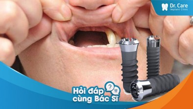 [Hỏi đáp bác sĩ] Mất răng trong một thời gian dài, trồng trụ Implant Thụy Sĩ khôi phục chức năng răng miệng được không?