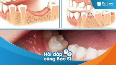 [Hỏi đáp bác sĩ] Mất răng lâu năm có ảnh hưởng đến răng xung quanh không? Trồng trụ Implant Thụy Sĩ có khắc phục được không?