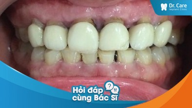 [Hỏi đáp bác sĩ] - Tác hại của việc răng thật bị mục nát sau khi mài răng bọc sứ 