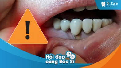 [Hỏi đáp bác sĩ] - Cách khắc phục tình trạng răng thật bị mục nát sau khi mài răng bọc sứ? 