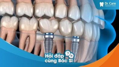 [Hỏi đáp bác sĩ] - Vì sao nên lựa chọn dòng trụ Implant Đức khi trồng răng Implant?
