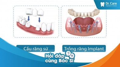 [Hỏi đáp bác sĩ] - Đang sử dụng cầu răng sứ, liệu có thể thay thế bằng trồng răng Implant Đức được không