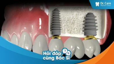 [Hỏi đáp bác sĩ] Tình trạng mất răng lâu năm có thể ảnh hưởng đến quá trình hàn gắn và tích hợp của trụ Implant Đức không?