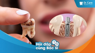 [Hỏi đáp bác sĩ] - Sâu răng có ảnh hưởng đến khả năng lành thương sau khi trồng trụ Implant Đức không?