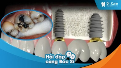 [Hỏi đáp bác sĩ] Bị sâu răng trồng trụ Implant Đức có gây biến chứng gì hay không?