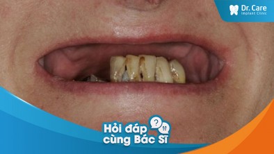 [Hỏi đáp bác sĩ] - Mất răng lâu năm có ảnh hưởng sức khoẻ răng miệng không? Trồng trụ Implant Đức có giải quyết được không?