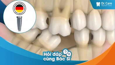 [Hỏi đáp bác sĩ] - Tình trạng mất răng lâu năm có thể gây ra những vấn đề về hàm răng xung quanh không? Trụ Implant Đức có thể giúp tôi giải quyết những vấn đề này không?
