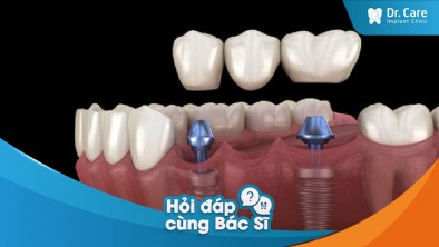 [Hỏi đáp bác sĩ] - Cách chọn răng sứ phù hợp với tài chính trước khi trồng răng sứ trên Implant
