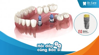 [Hỏi đáp bác sĩ] - Mất răng lâu năm, các răng xung quanh xô lệch, tụt về khoảng mất răng. Trồng Implant Mỹ có khắc phục được không?