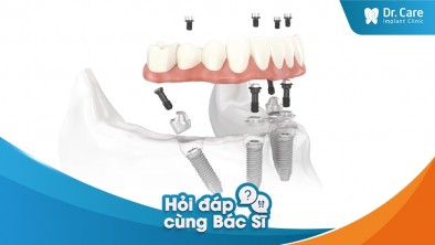 [Hỏi đáp bác sĩ] - Bị mất răng toàn hàm, có nên trồng nhiều răng sứ trên Implant?