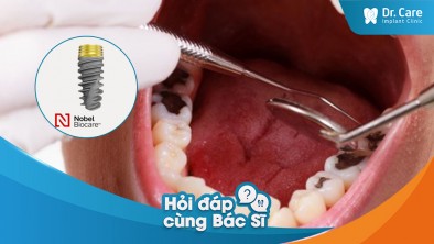 [Hỏi đáp bác sĩ] - Đang điều trị sâu răng có thể trồng răng Implant với trụ Implant Mỹ không?