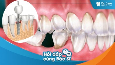 [Hỏi đáp bác sĩ] - Trồng răng sứ trên Implant ngay khi nhổ răng có tiết kiệm chi phí không?