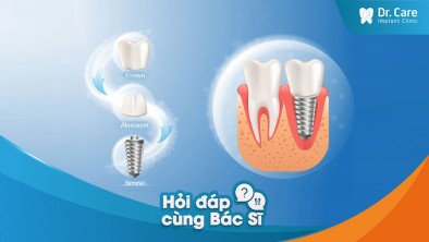 [Hỏi đáp bác sĩ] - Vì sao chi phí trồng răng sứ trên Implant lại cao hơn phương pháp khác?