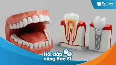 [Hỏi đáp bác sĩ] - Nên thực hiện trồng răng sứ trên Implant trả góp hay trồng răng sứ giá rẻ?