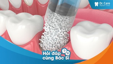 [Hỏi đáp bác sĩ] - Bị tiêu xương hàm có phát sinh chi phí trồng răng sứ trên Implant không?