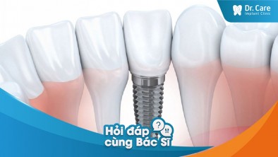 [Hỏi đáp bác sĩ] - 6 ưu điểm của phương pháp trồng răng sứ trên Implant?