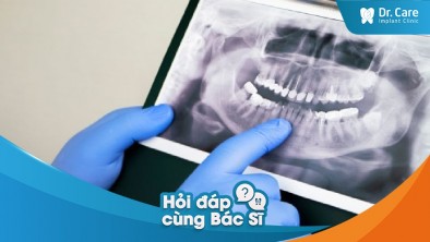 [Hỏi đáp bác sĩ] - Chi phí trồng răng sứ trên Implant có thay đổi theo vị trí mất răng không?