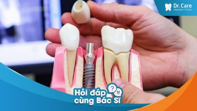 [Hỏi đáp bác sĩ] - Trồng răng sứ trên Implant có những ưu đãi thanh toán nào?