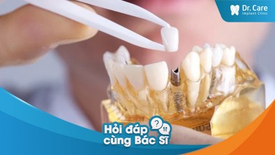 [Hỏi đáp bác sĩ] - Trồng răng sứ trên Implant bao lâu thì sẽ tốn chi phí thay răng mới?