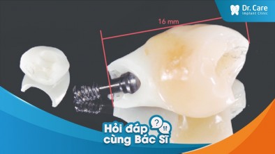 [Hỏi đáp bác sĩ] - Vai trò của Customized Abutment trong trồng răng Implant