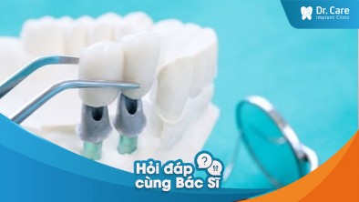 [Hỏi đáp bác sĩ] - Số lượng răng bị mất có tác động đến quá trình trồng răng Implant không?