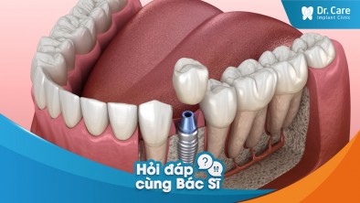 [Hỏi đáp bác sĩ] - Vùng mất răng có ảnh hưởng đến khả năng trồng Implant không?