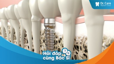 [Hỏi đáp bác sĩ] - Bị loãng xương cần thực hiện các xét nghiệm gì để biết có trồng răng Implant được hay không?