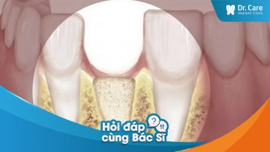 [Hỏi đáp bác sĩ] - Người bị tiêu xương hàm cần làm gì khi trồng răng Implant?