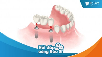 [Hỏi đáp bác sĩ] - Khả năng đông máu có ảnh hưởng đến quá trình trồng răng Implant không?
