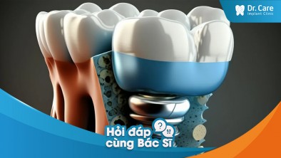 [Hỏi đáp bác sĩ] - Chất lượng của xương hàm có ảnh hưởng đến khả năng thành công khi trồng răng Implant không?