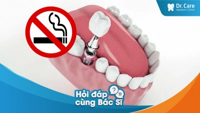 [Hỏi đáp bác sĩ] - Cần ngưng sử dụng thuốc lá, rượu bia bao lâu trước khi trồng răng Implant?