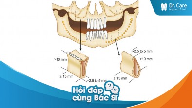 [Hỏi đáp bác sĩ] - Chỉ số HU khi kiếm tra xương hàm là gì? HU cần bao nhiêu mới đủ điều kiện trồng răng Implant