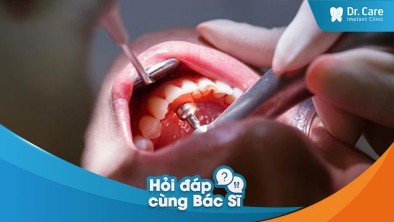 [Hỏi đáp bác sĩ] - Độ đàn hồi của nướu có ảnh hưởng đến khả năng trồng răng Implant không?