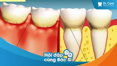 [Hỏi đáp bác sĩ] - Có mối liên kết nào giữa việc mất răng và bệnh viêm nướu không?