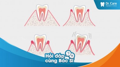 [Hỏi đáp bác sĩ] - Việc mất răng có thể là dấu hiệu của bệnh lý nào khác trong cơ thể không?