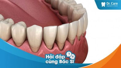 [Hỏi đáp bác sĩ] - Có thể bị biến chứng nào sau khi mất răng do viêm nướu không?