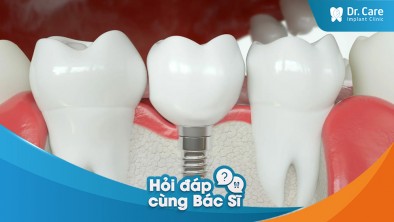 [Hỏi đáp bác sĩ] - Có những lựa chọn phục hồi răng nào khi mất răng? Lựa chọn nào tốt nhất?