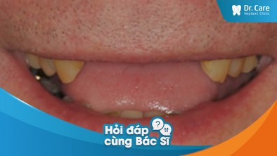 [Hỏi đáp bác sĩ] - Có bất kỳ biện pháp phục hồi nào có thể giúp cải thiện mất răng nguyên hàm trên không?