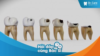 [Hỏi đáp bác sĩ] - Những bệnh lý nào có thể dẫn đến việc mất răng?