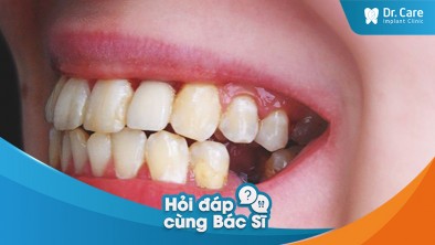 [Hỏi đáp bác sĩ] - Việc mất răng ở tuổi trẻ có khác gì so với việc mất răng ở người lớn tuổi không?