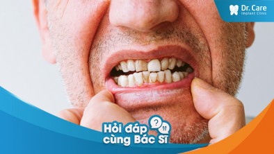 [Hỏi đáp bác sĩ] - Sức khoẻ tổng thể ảnh hưởng ra sao khi mất răng?