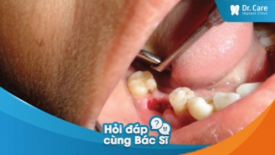 [Hỏi đáp bác sĩ] - Những nguy cơ nào về viêm nhiễm hoặc bệnh lý khác trong miệng sau khi mất răng có thể xảy ra?
