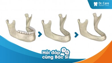 [Hỏi đáp bác sĩ] - Mất răng tòan hàm gây tiêu xương hàm ra sao?