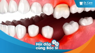 [Hỏi đáp bác sĩ] - Mất răng có thể ảnh hưởng đến cấu trúc xương hàm ra sao?