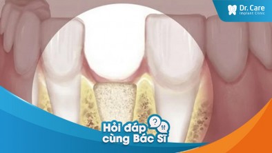 [Hỏi đáp bác sĩ] - Mất răng có thể ảnh hưởng đến sự cân bằng hóa học trong cơ thể không?