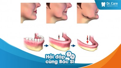 [Hỏi đáp bác sĩ] - Mất răng hết 2 hàm có thể ảnh hưởng đến sự cân bằng và hình dạng của xương hàm ra sao?