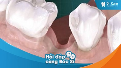 [Hỏi đáp bác sĩ] - Mất răng có thể tác động đến độ rộng của xương hàm không?