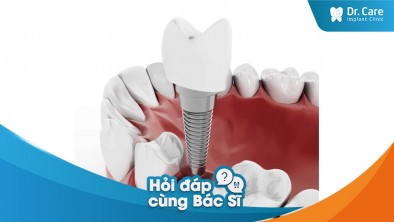 [Hỏi đáp bác sĩ] - Phương pháp phục hồi nào cải thiện được cấu trúc xương hàm sau khi mất răng?