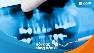 [Hỏi đáp bác sĩ] - Làm thế nào để xác định tác động của việc mất răng đến xương hàm?